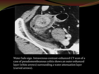 CT Imaging of Bowel Wall Thickening | PPTX
