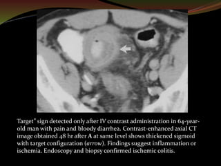 CT Imaging of Bowel Wall Thickening | PPTX