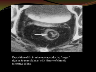 CT Imaging of Bowel Wall Thickening | PPTX