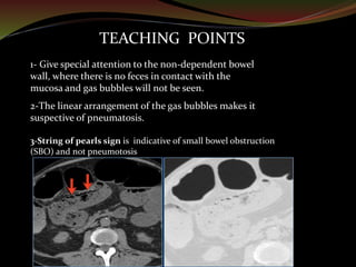CT Imaging of Bowel Wall Thickening | PPTX