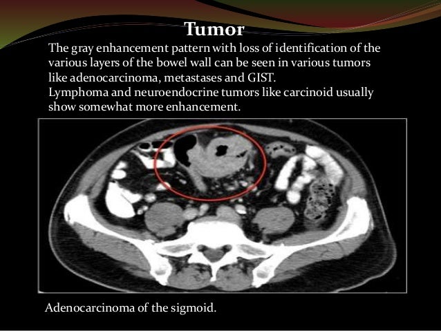 CT Imaging of Bowel Wall Thickening