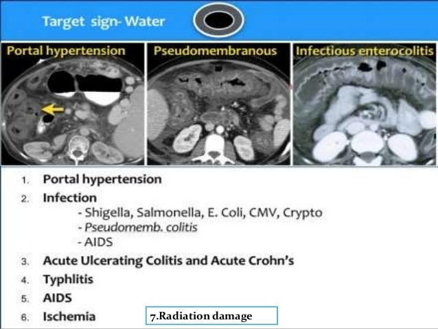 Ct Imaging Of Bowel Wall Thickening