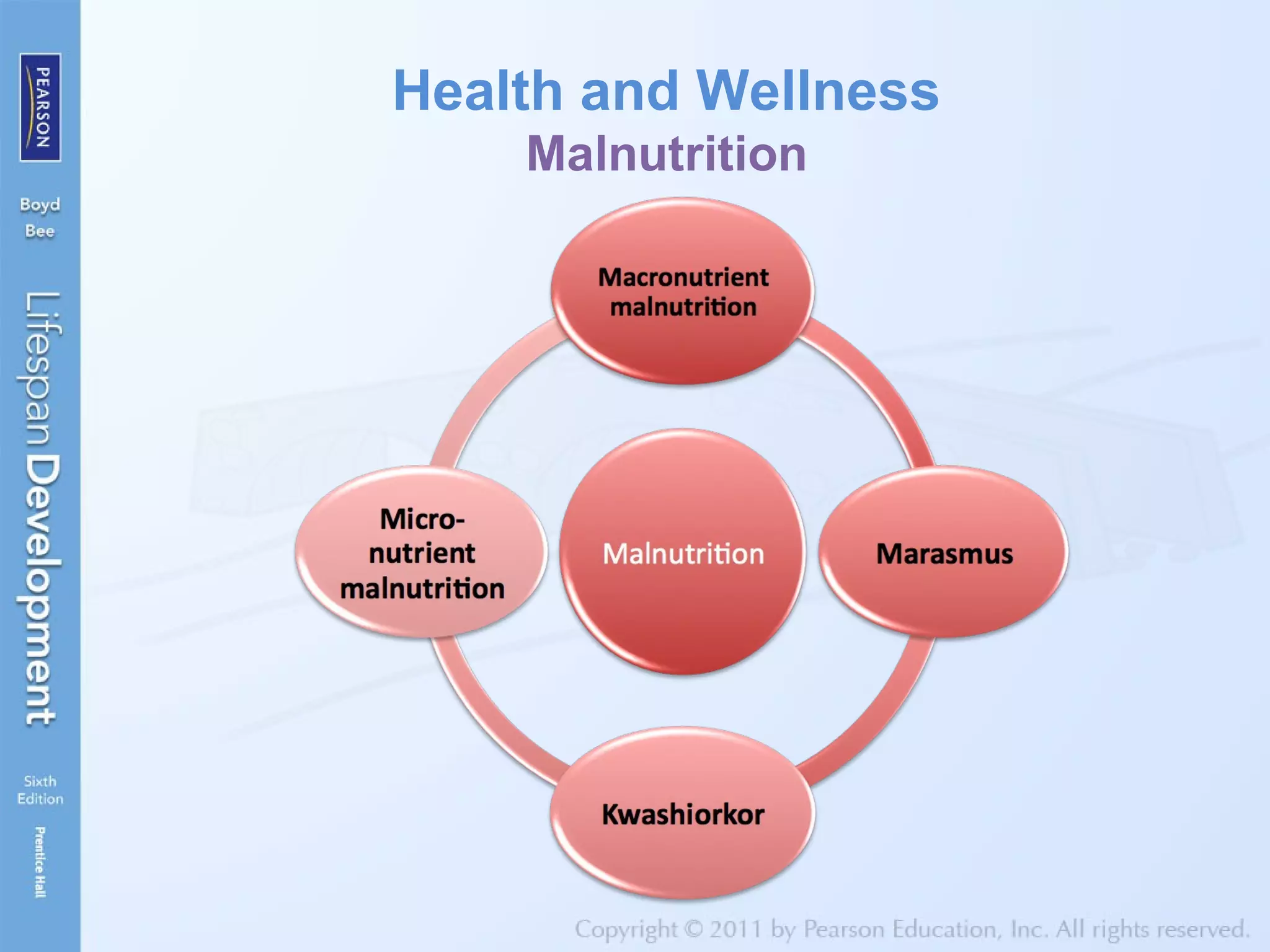 Health and Wellness
Malnutrition
 