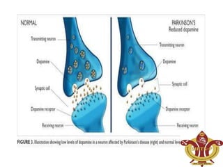 Parkinson's disease & pathophysiology 