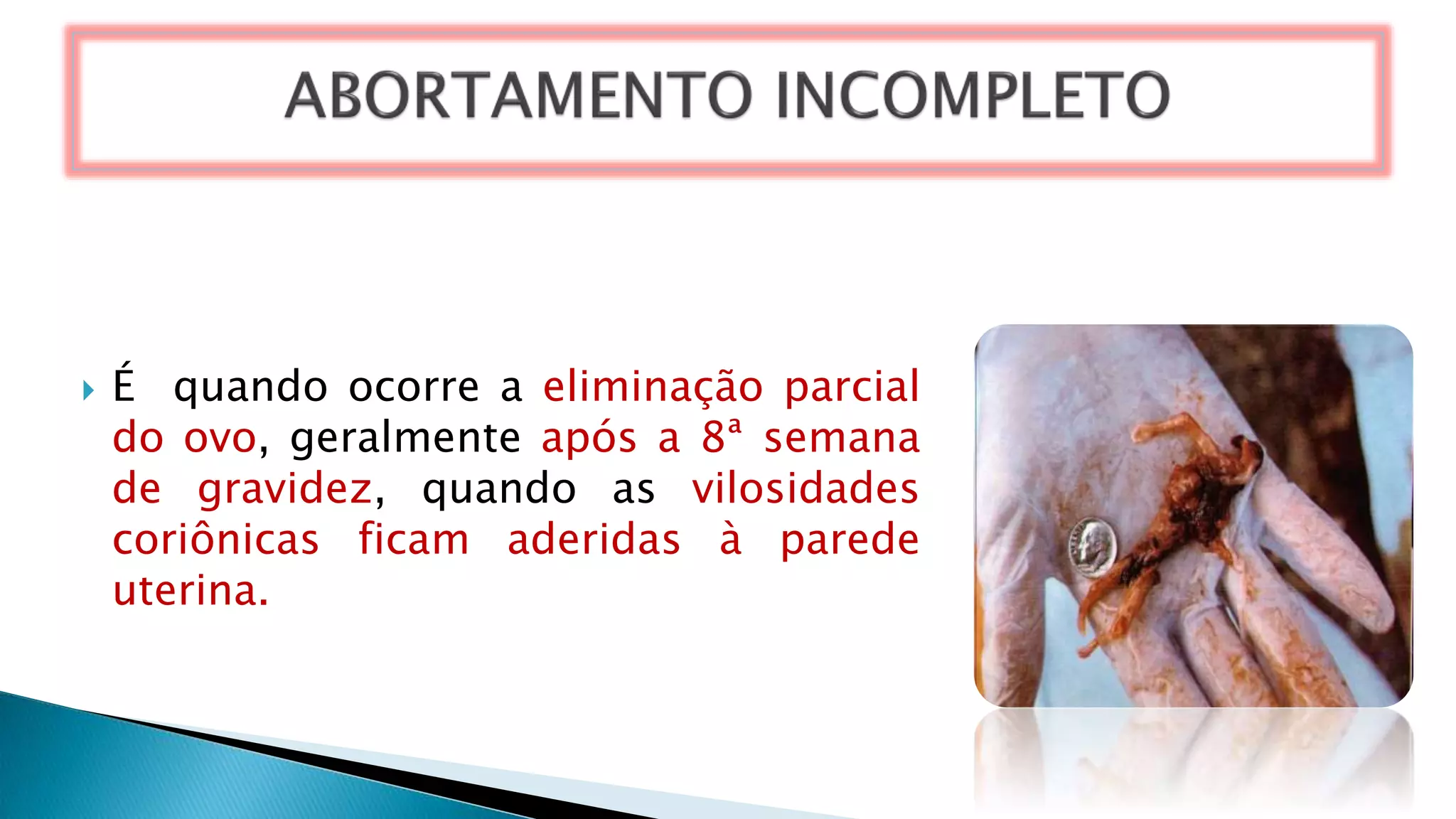  É quando ocorre a eliminação parcial
do ovo, geralmente após a 8ª semana
de gravidez, quando as vilosidades
coriônicas ficam aderidas à parede
uterina.
 