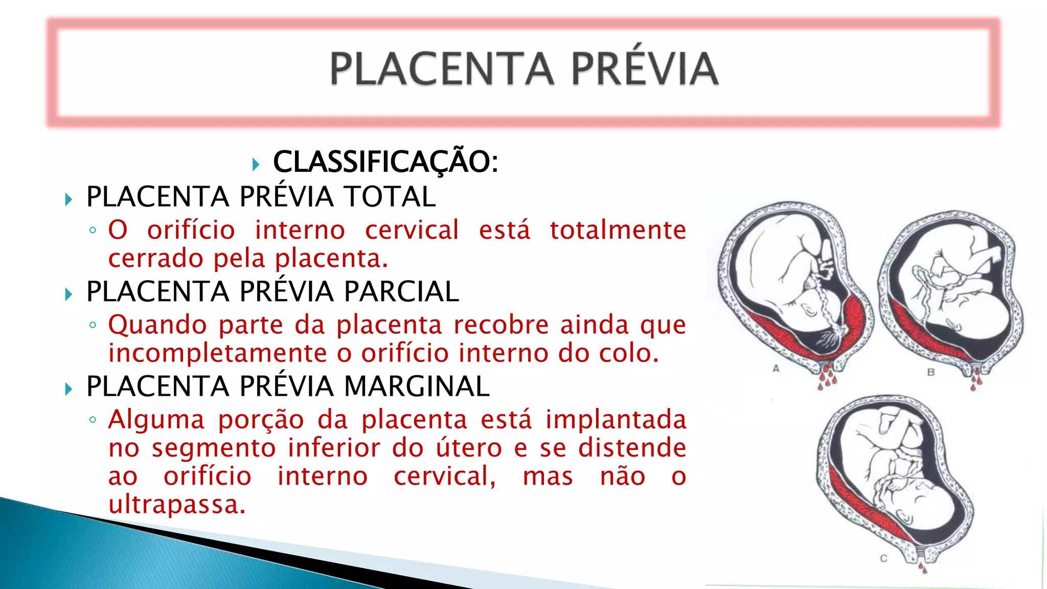  CLASSIFICAÇÃO:
 PLACENTA PRÉVIA TOTAL
◦ O orifício interno cervical está totalmente
cerrado pela placenta.
 PLACENTA PRÉVIA PARCIAL
◦ Quando parte da placenta recobre ainda que
incompletamente o orifício interno do colo.
 PLACENTA PRÉVIA MARGINAL
◦ Alguma porção da placenta está implantada
no segmento inferior do útero e se distende
ao orifício interno cervical, mas não o
ultrapassa.
 