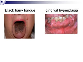 Black hairy tongue gingival hyperplasia
 
