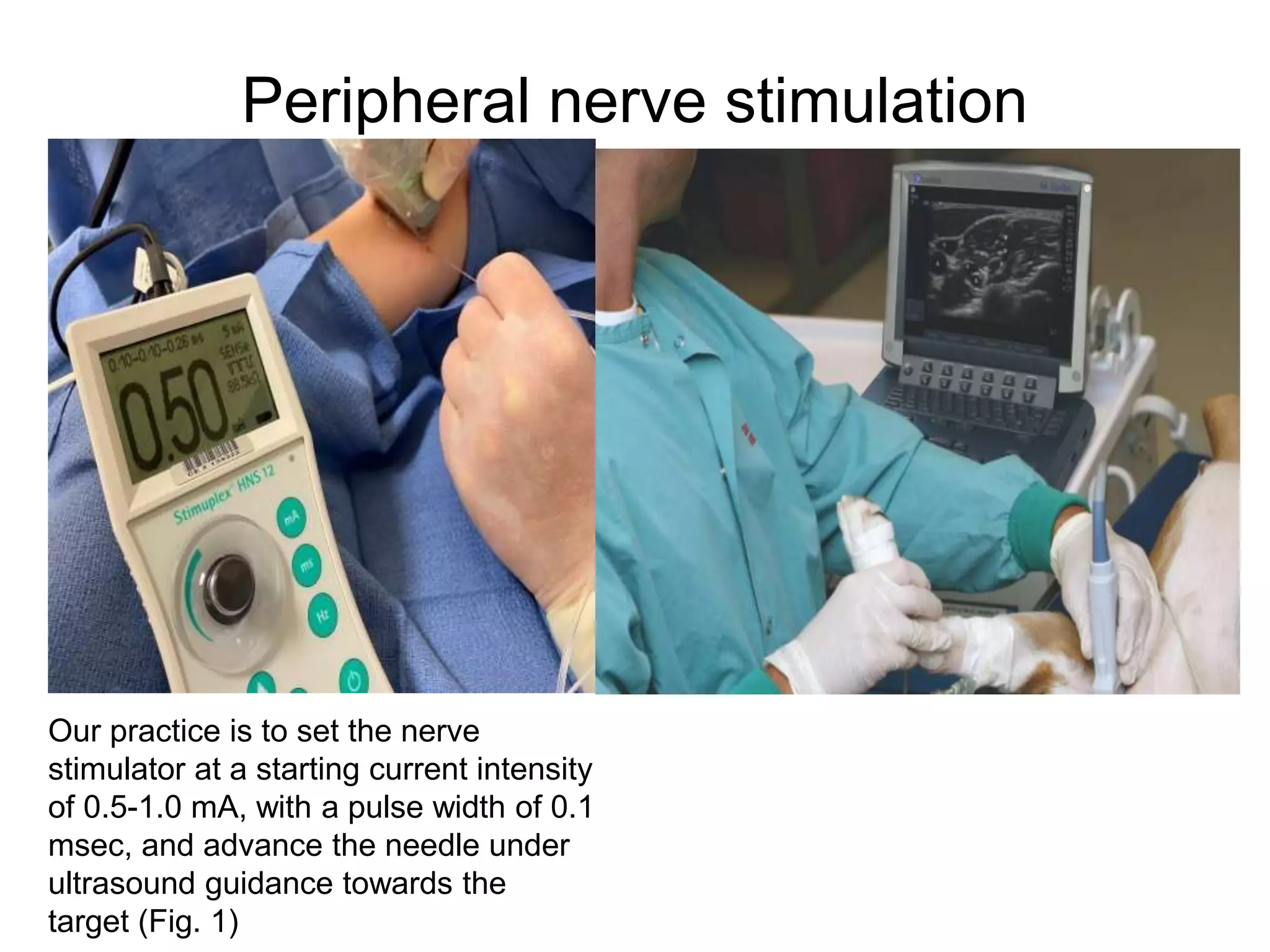 Peripheral nerve stimulation
Our practice is to set the nerve
stimulator at a starting current intensity
of 0.5-1.0 mA, with a pulse width of 0.1
msec, and advance the needle under
ultrasound guidance towards the
target (Fig. 1)
 