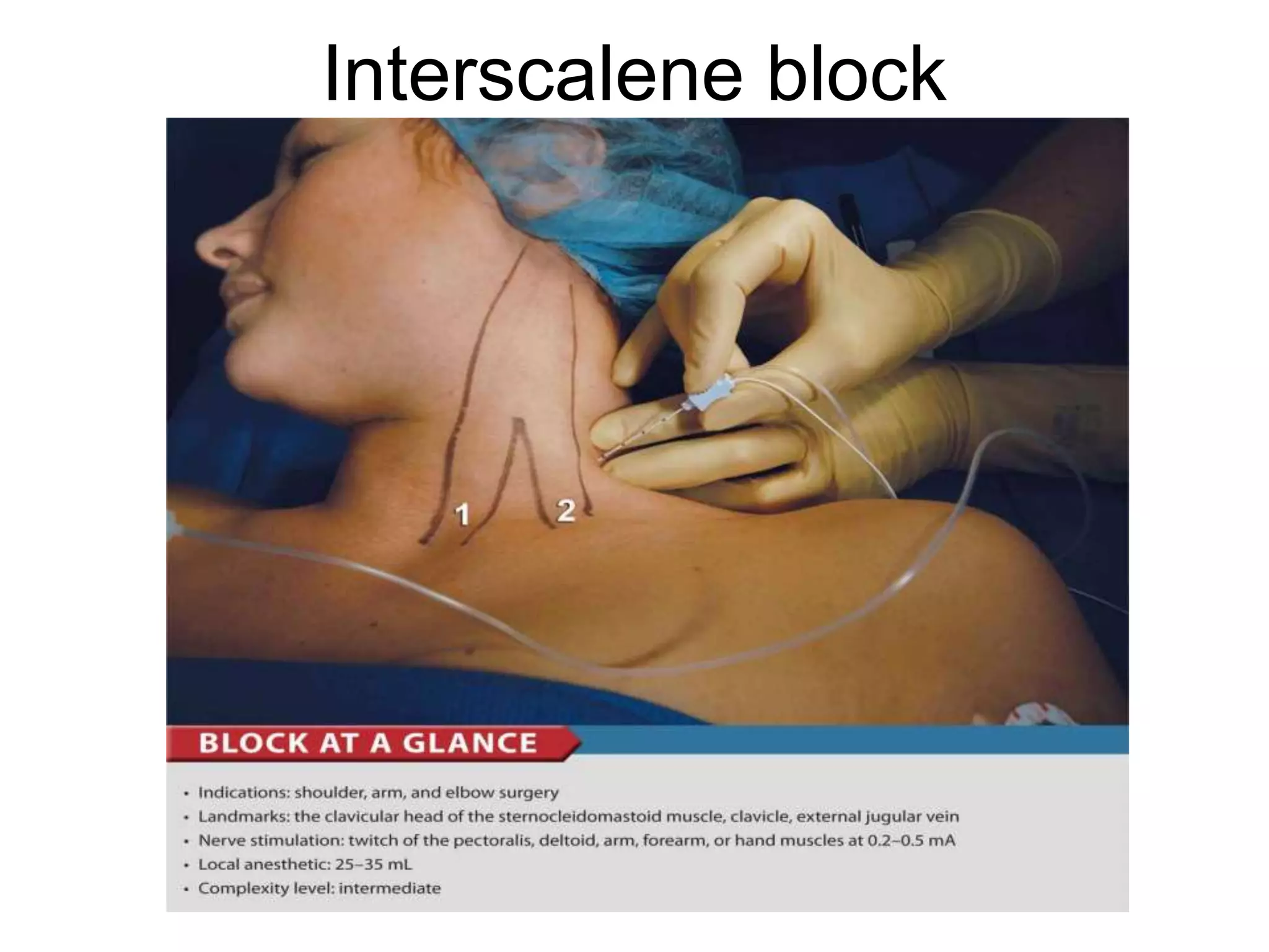 Interscalene block
 