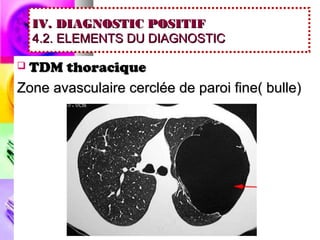 IV. DIAGNOSTIC POSITIF
    4.2. ELEMENTS DU DIAGNOSTIC

TDM thoracique
Zone avasculaire cerclée de paroi fine( bulle)
 