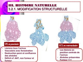III. HISTOIRE NATURELLE
      3.2.1. MODIFICATION STRUCTURELLE




- Lésions tous l’acinus
- Vasculaire avec fenestration      - Les lésions en
- Destruction paroi et confluence     position centrale de
  des alvéoles                        l’acinus
- Déficit α1 AAT, non fumeur et     - Alvéoles préservées
  fumeur                            - Fumeur +++
 