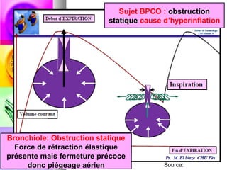 Sujet BPCO : obstruction
                           statique cause d’hyperinflation




Bronchiole: Obstruction statique
  Force de rétraction élastique
présente mais fermeture précoce
     donc piégeage aérien                 Source:
 