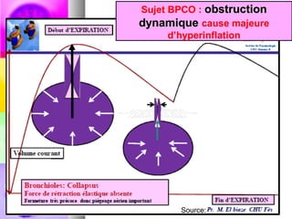 Sujet BPCO : obstruction
dynamique cause majeure
      d’hyperinflation




       Source:
 