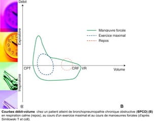 Courbes débit-volume chez un patient atteint de bronchopneumopathie chronique obstructive (BPCO) (B)
en respiration calme (repos), au cours d'un exercice maximal et au cours de manoeuvres forcées (d'après
Similowski T et coll).
 