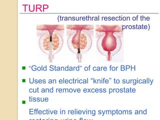 TURP
             (transurethral resection of the
                                   prostate)




n   ―Gold Standard‖ of ...