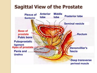 Sagittal View of the Prostate
            Plexus of   Anterior   Middle
                        lobe       lobe   Posterio...