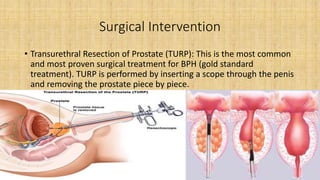 Surgical Intervention
• Transurethral Resection of Prostate (TURP): This is the most common
and most proven surgical treatment for BPH (gold standard
treatment). TURP is performed by inserting a scope through the penis
and removing the prostate piece by piece.
 