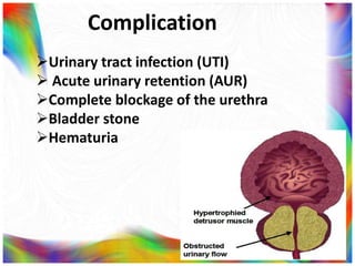 Complication
Urinary tract infection (UTI)
 Acute urinary retention (AUR)
Complete blockage of the urethra
Bladder stone
Hematuria
 