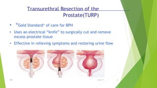 • “Gold Standard” of care for BPH
• Uses an electrical “knife” to surgically cut and remove
excess prostate tissue
• Effective in relieving symptoms and restoring urine flow
Transurethral Resection of the
Prostate(TURP)
BPH 226-Apr-19
 