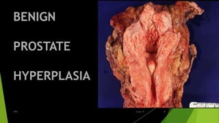 BENIGN
PROSTATE
HYPERPLASIA
BPH 86-Apr-19
 