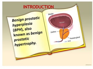 Benign Prostate Hyperplasia | PPTX