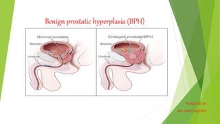 Benign prostatic hyperplasia (BPH)
PRESENTED BY:
MR: ABHAY RAJPOOT
 