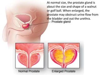 At normal size, the prostate gland is
about the size and shape of a walnut
or golf ball. When enlarged, the
prostate may obstruct urine flow from
the bladder and out the urethra.
 