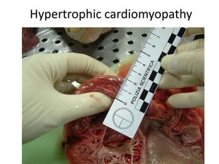 Hypertrophic cardiomyopathy
 