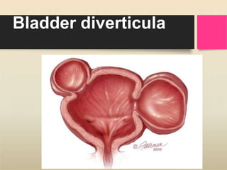 Bladder diverticula
 