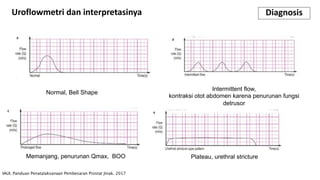 Uroflowmetri dan interpretasinya Diagnosis
IAUI. Panduan Penatalaksanaan Pembesaran Prostat Jinak. 2017
Normal, Bell Shape
Memanjang, penurunan Qmax, BOO
Intermittent flow,
kontraksi otot abdomen karena penurunan fungsi
detrusor
Plateau, urethral stricture
 
