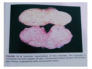 BPH or NODULAR HYPERPLASIA of Prostate BPH.pptx