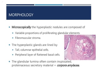 BPH or NODULAR HYPERPLASIA of Prostate BPH.pptx