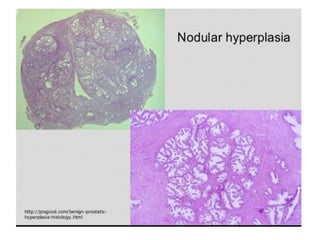 BPH or NODULAR HYPERPLASIA of Prostate BPH.pptx