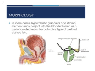 BPH or NODULAR HYPERPLASIA of Prostate BPH.pptx