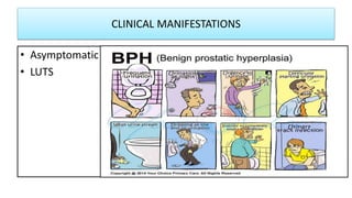 CLINICAL MANIFESTATIONS
• Asymptomatic
• LUTS
 