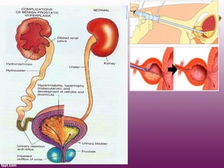benign prostatic hyperplasia