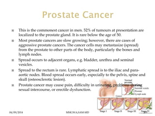  This is the commonest cancer in men. 52% of tumours at presentation are 
localized to the prostate gland. It is rare bel...