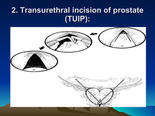2. Transurethral incision of prostate (TUIP): 