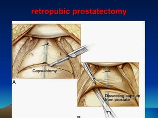retropubic prostatectomy 
