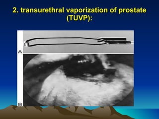 2. transurethral vaporization of prostate (TUVP): 