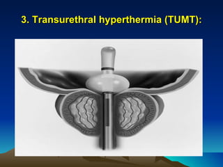 3. Transurethral hyperthermia (TUMT): 