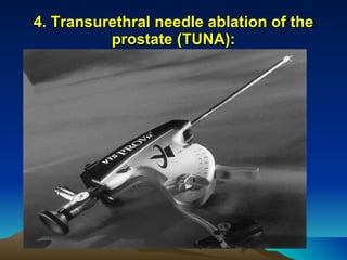 4. Transurethral needle ablation of the prostate (TUNA): 