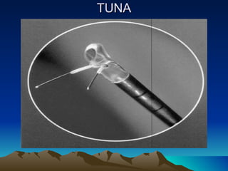 TUNA 