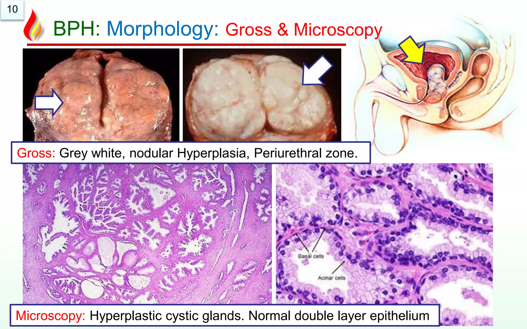 10
BPH: Morphology: Gross & Microscopy
Gross: Grey white, nodular Hyperplasia, Periurethral zone.
Microscopy: Hyperplastic cystic glands. Normal double layer epithelium
 