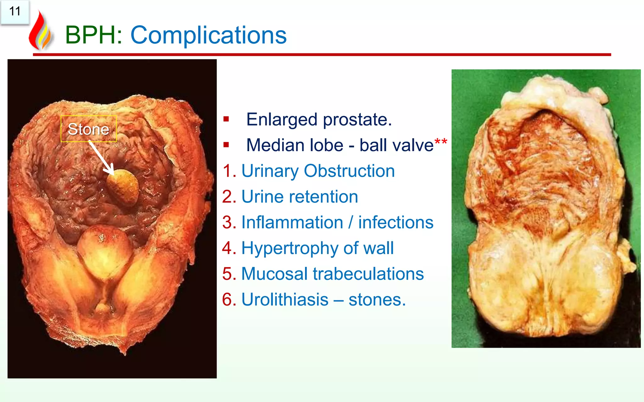 11
BPH: Complications
 Enlarged prostate.
 Median lobe - ball valve**
1. Urinary Obstruction
2. Urine retention
3. Inflammation / infections
4. Hypertrophy of wall
5. Mucosal trabeculations
6. Urolithiasis – stones.
Stone
 