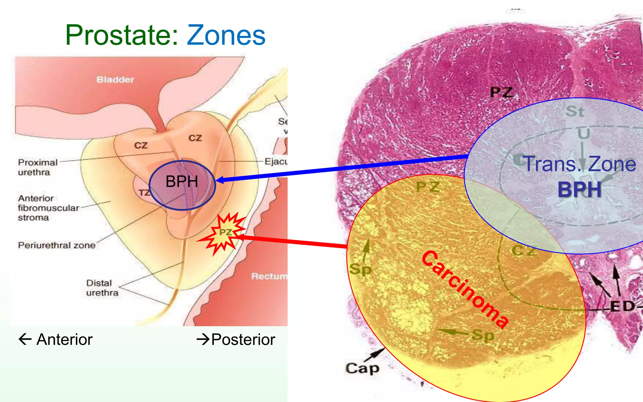 Prostate: Zones
Trans. Zone
BPHBPH
Posterior Anterior
 