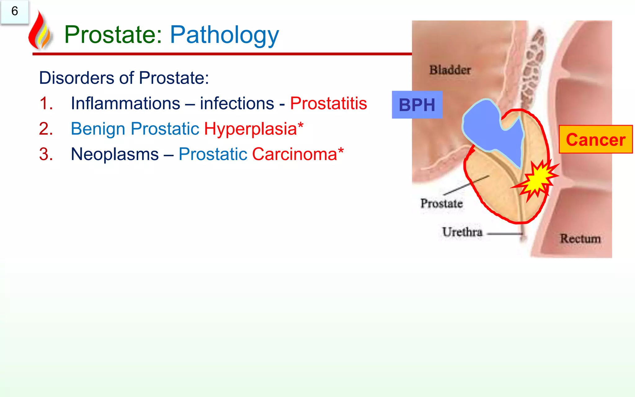 6
Prostate: Pathology
Disorders of Prostate:
1. Inflammations – infections - Prostatitis
2. Benign Prostatic Hyperplasia*
3. Neoplasms – Prostatic Carcinoma*
BPH
Cancer
 