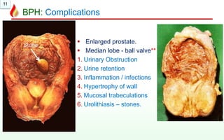 11
BPH: Complications
 Enlarged prostate.
 Median lobe - ball valve**
1. Urinary Obstruction
2. Urine retention
3. Inflammation / infections
4. Hypertrophy of wall
5. Mucosal trabeculations
6. Urolithiasis – stones.
Stone
 