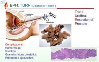 12
BPH: TURP (Diagnosis + Treat )
Trans
Urethral
Resection of
Prostate
Complications:
Hemorrhage,
Infection,
Granulomatous prostatitis
Retrograde ejaculation.
 