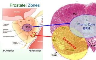 Prostate: Zones
Trans. Zone
BPHBPH
Posterior Anterior
 